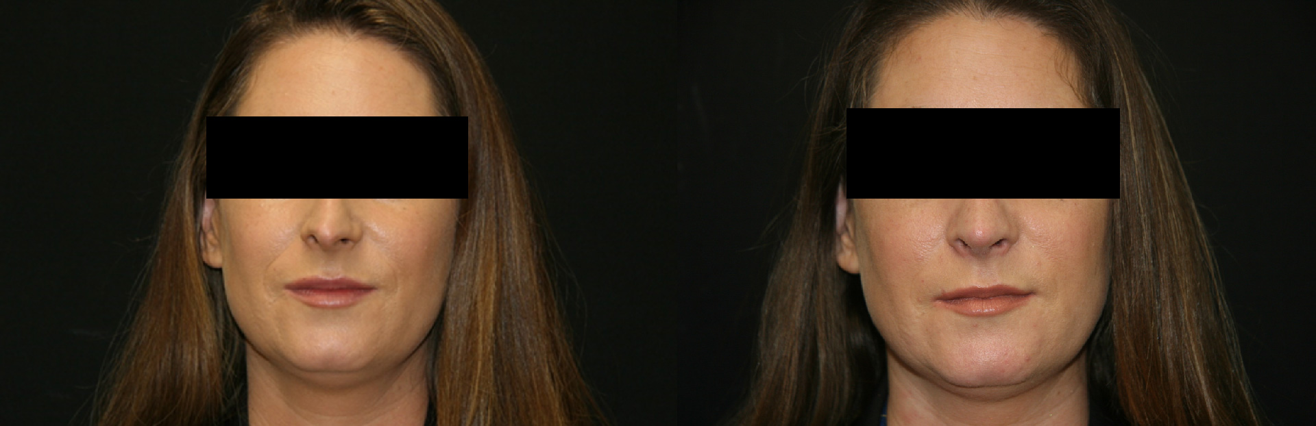 Rhinoplasty - 6 weeks post op