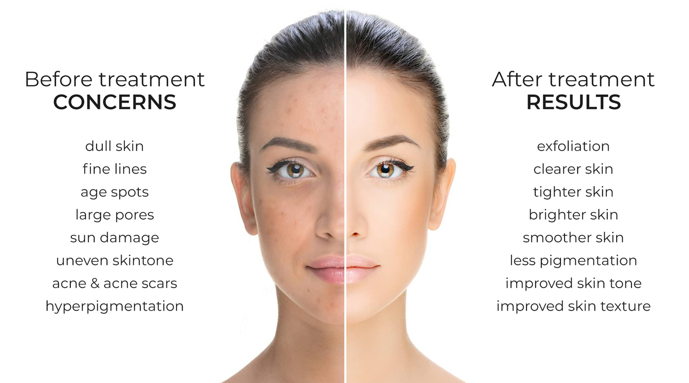 Image showing the benefits of a chemical skin peel