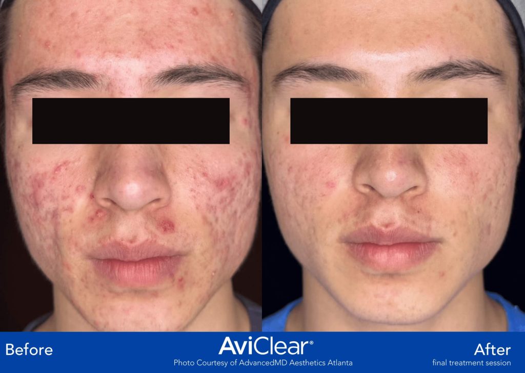 AdvancedMD Aesthetics Atlanta AviClear Acne treatment before and after