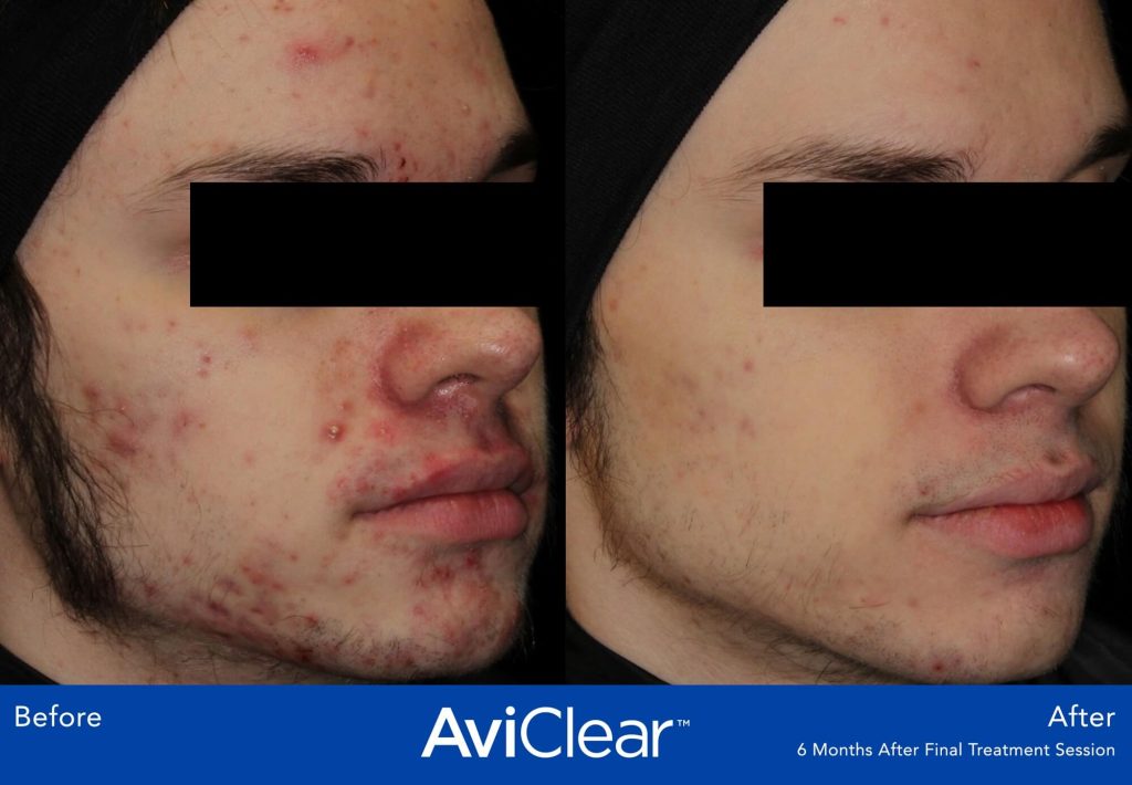 AviClear Acne Treatment before and after