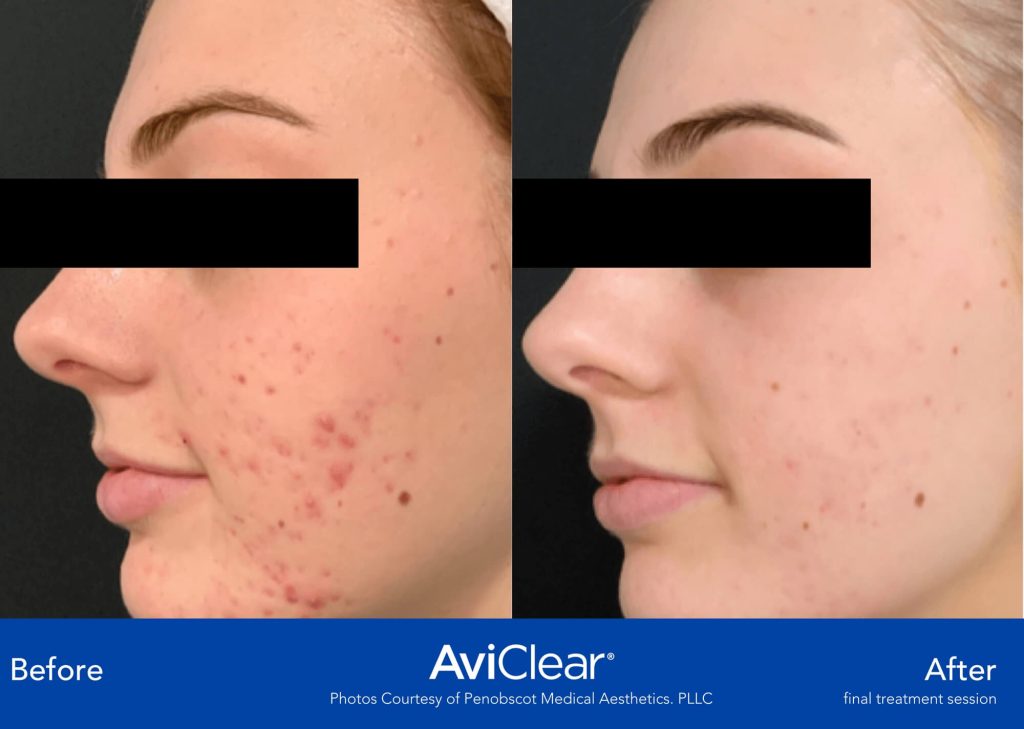 Penobscot Medical Aesthetics. PLLC AviClear Acne treatment before and after